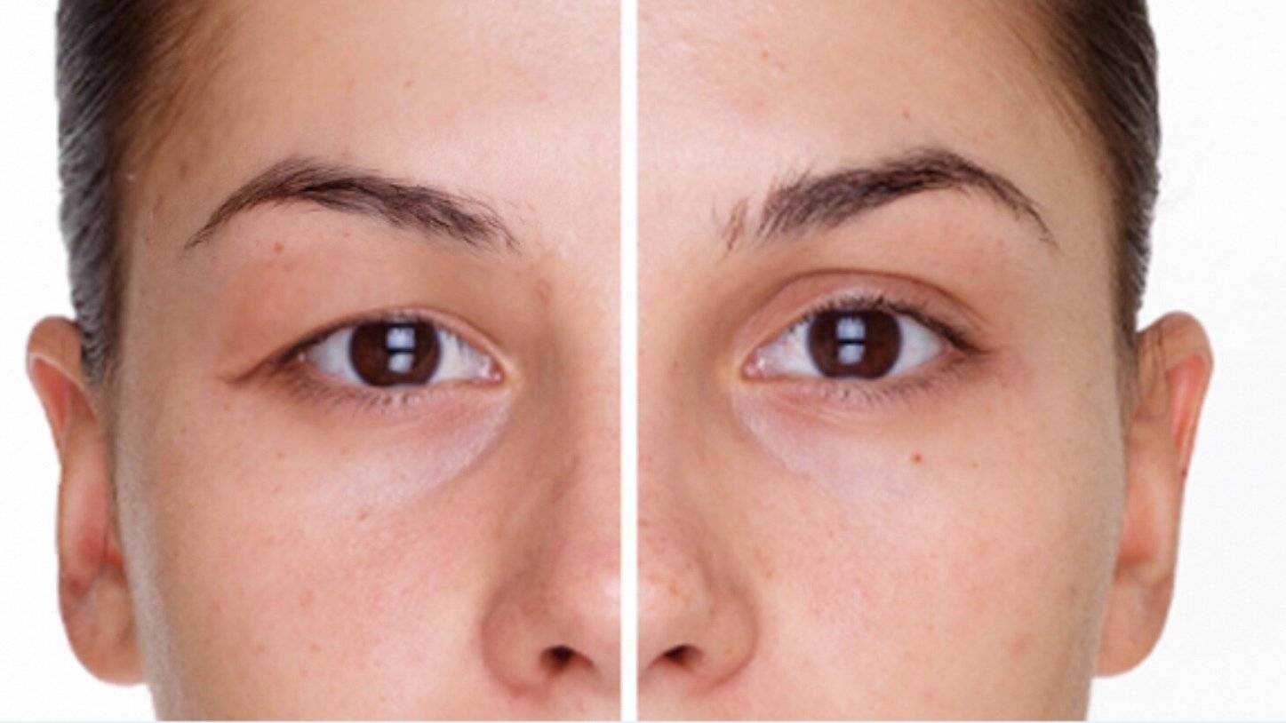 dr akyol goz kapaklarindaki sarkmalar gorme guclugune yol acabiliyor RdF6C3WV